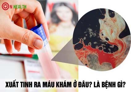 Xuất tinh ra máu khám ở đâu, là bệnh gì và cách chữa an toàn