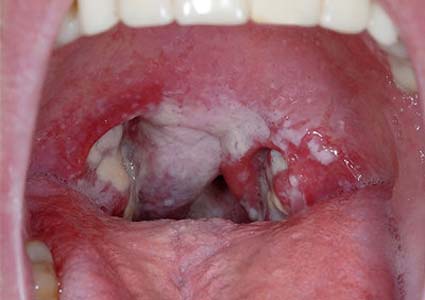 Hình ảnh bệnh lậu ở nữ giới, nam giới và ở miệng giai đoạn đầu