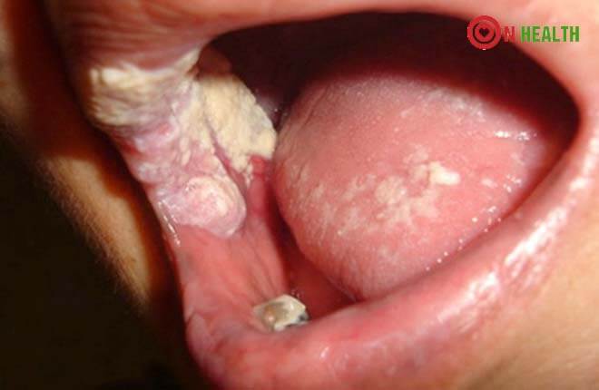 Dấu hiệu bị bệnh lậu ở miệng: tác hại và cách chữa