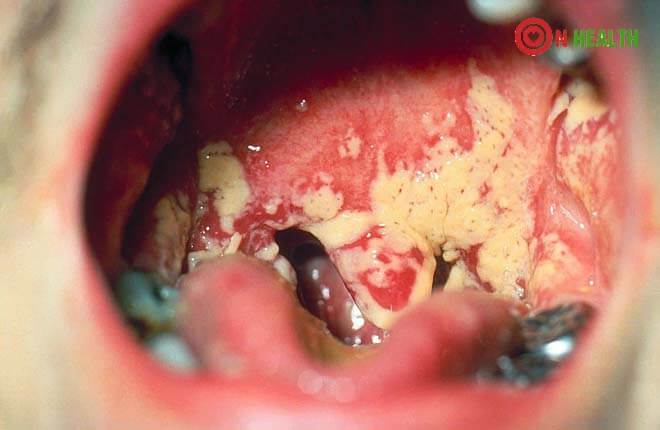Dấu hiệu bị bệnh lậu ở miệng: tác hại và cách chữa