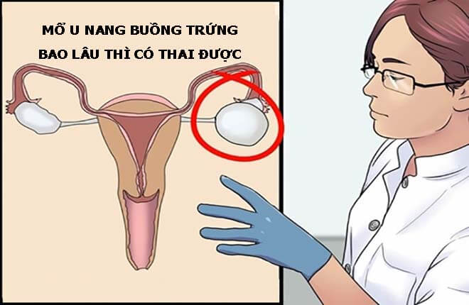 Mổ u nang buồng trứng bao lâu thì có thai được