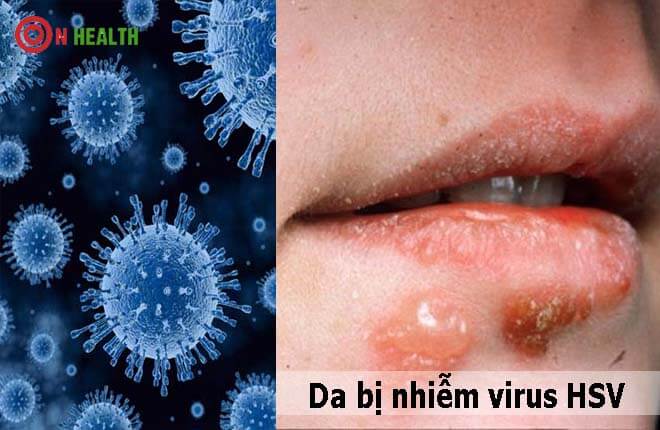 Da bị nhiễm virus HSV
