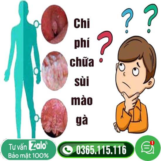 Chi phí chữa sùi mào gà hết bao nhiêu tiền giá năm 2025