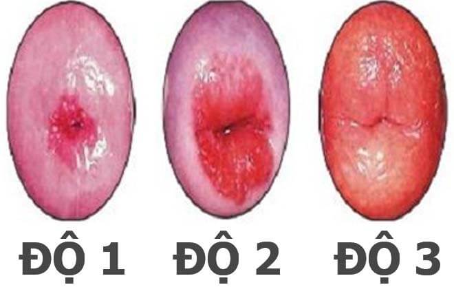 Hình ảnh viêm lộ tuyến cổ tử cung độ 1, 2, 3