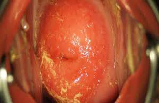 Hình ảnh viêm lộ tuyến cổ tử cung độ 1