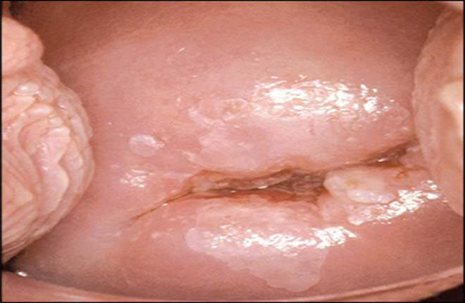 hình ảnh viêm lộ tuyến cổ tử cung