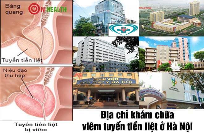 10 địa chỉ khám chữa viêm tuyến tiền liệt ở đâu tốt nhất Hà Nội